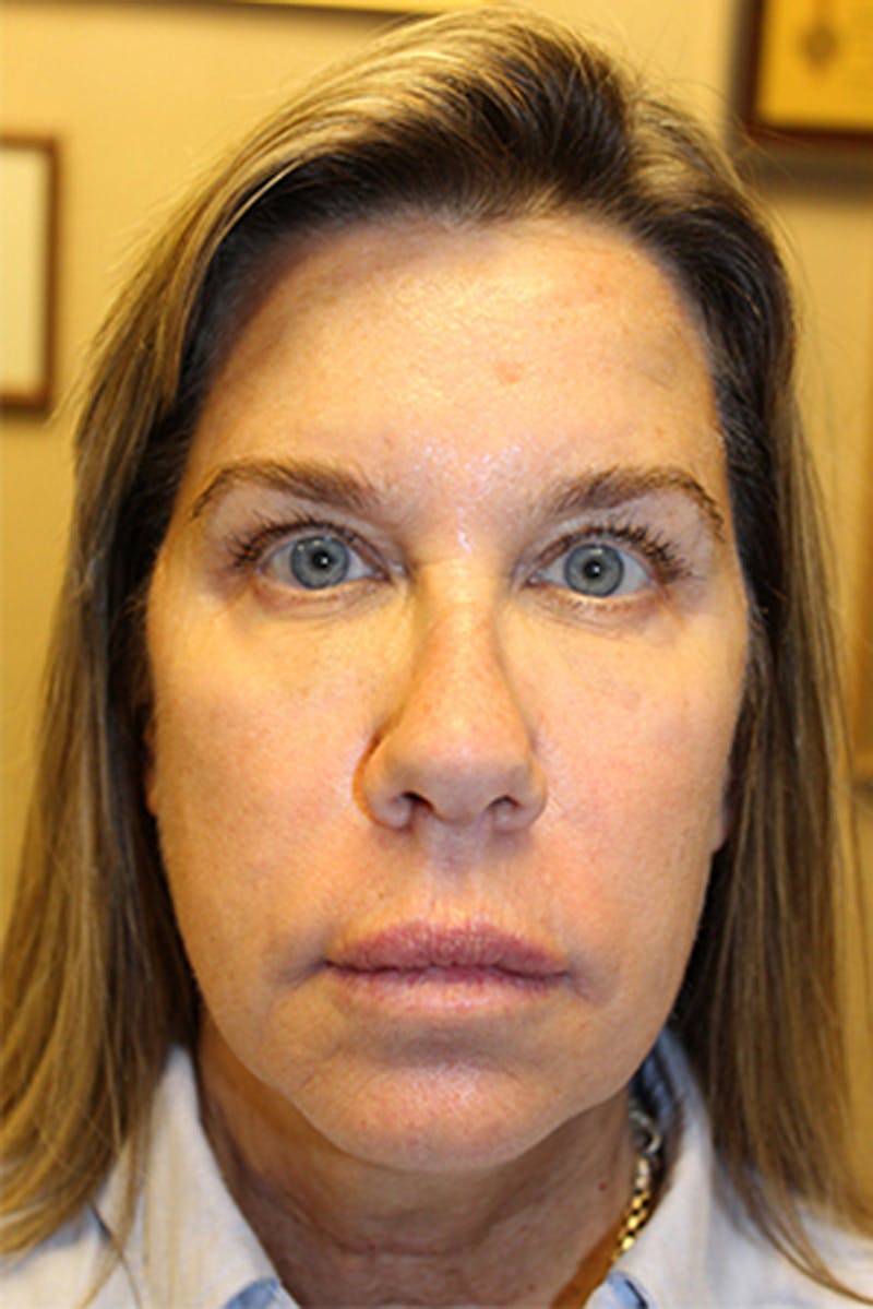 Injectables Before & After Gallery - Patient 174146593 - Image 3
