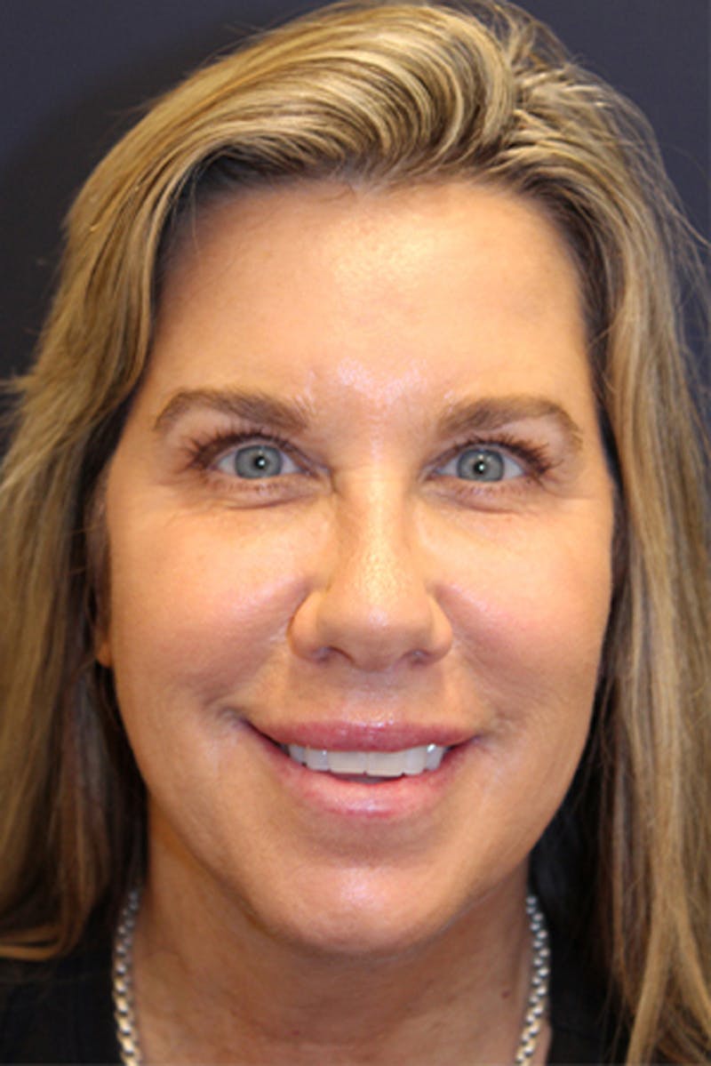 Injectables Before & After Gallery - Patient 174146593 - Image 4