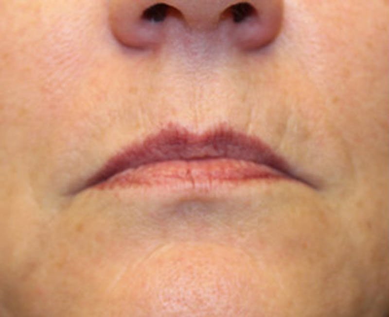 Injectables Before & After Gallery - Patient 174146598 - Image 1