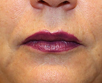 Injectables Before & After Gallery - Patient 174146598 - Image 2