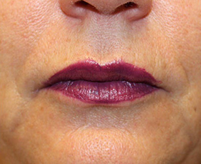 Injectables Before & After Gallery - Patient 174146598 - Image 2