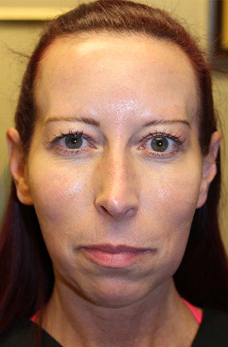 Injectables Before & After Gallery - Patient 174146605 - Image 1
