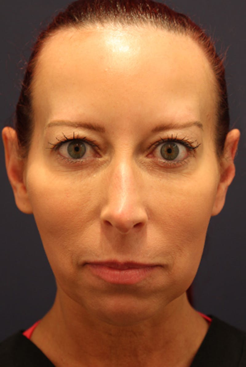 Injectables Before & After Gallery - Patient 174146605 - Image 2