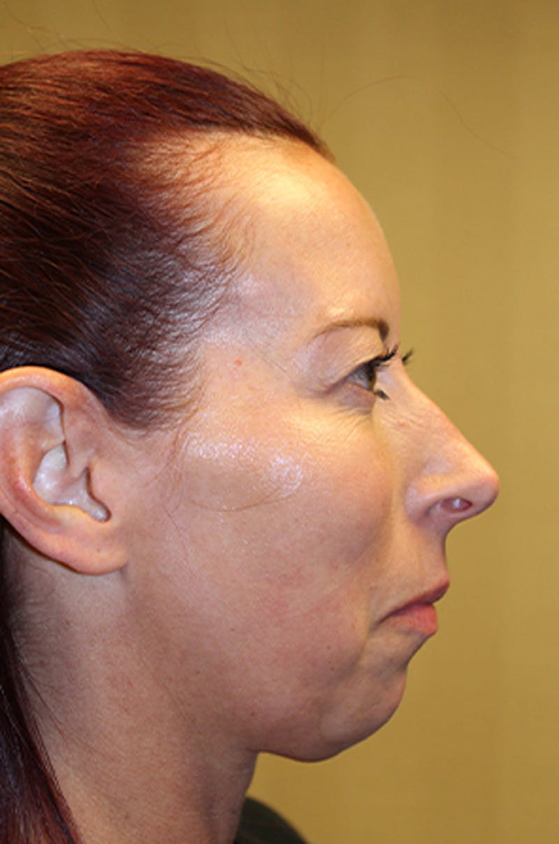 Injectables Before & After Gallery - Patient 174146605 - Image 3