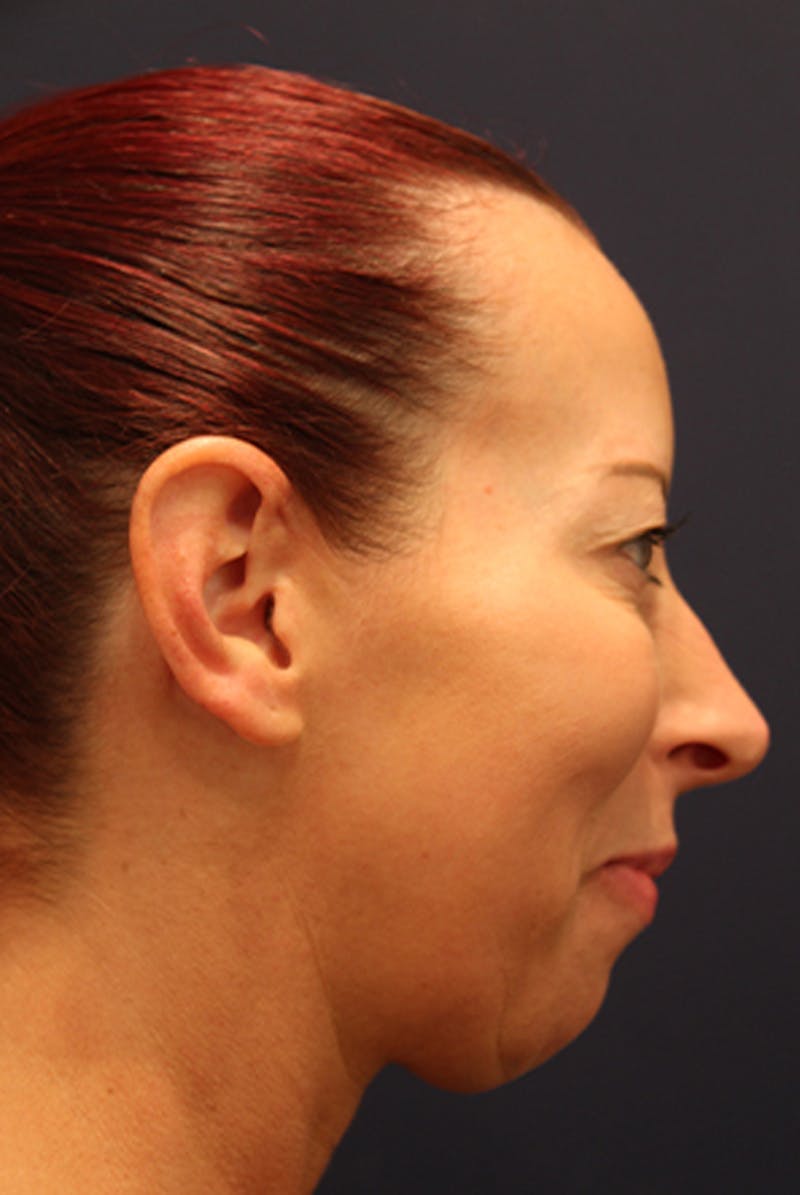 Injectables Before & After Gallery - Patient 174146605 - Image 4