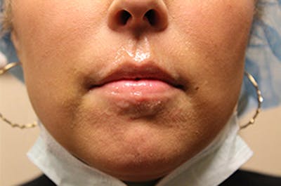Injectables Before & After Gallery - Patient 174146612 - Image 1