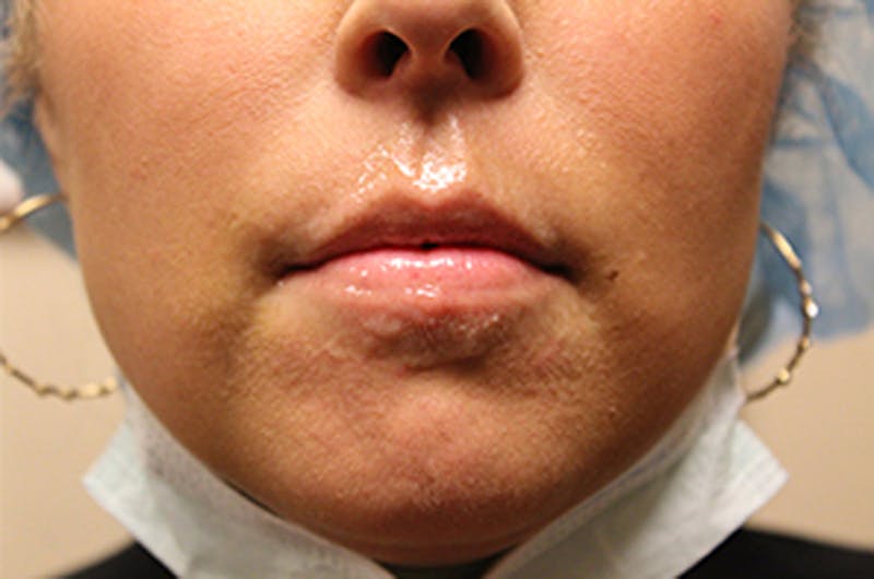 Injectables Before & After Gallery - Patient 174146612 - Image 1