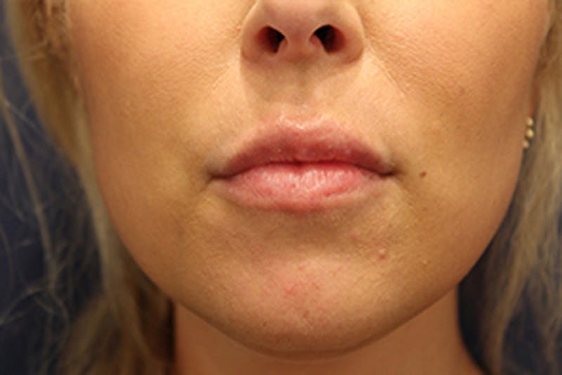 Injectables Before & After Gallery - Patient 174146612 - Image 2