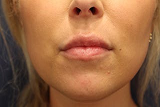 Injectables Before & After Gallery - Patient 174146612 - Image 2