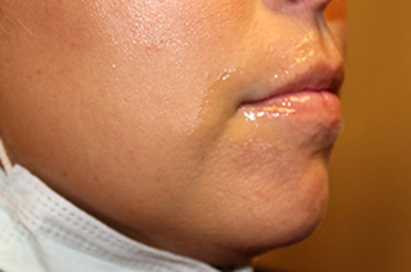 Injectables Before & After Gallery - Patient 174146612 - Image 3