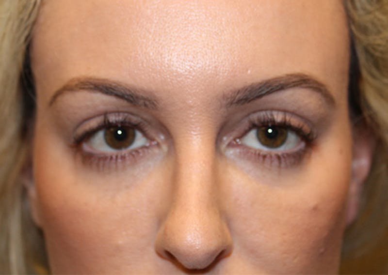 Injectables Before & After Gallery - Patient 174146619 - Image 1