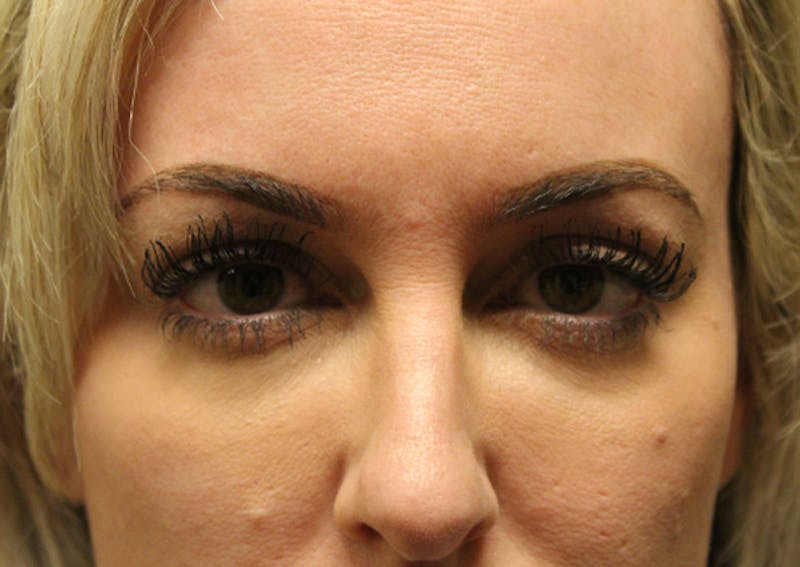 Injectables Before & After Gallery - Patient 174146619 - Image 2