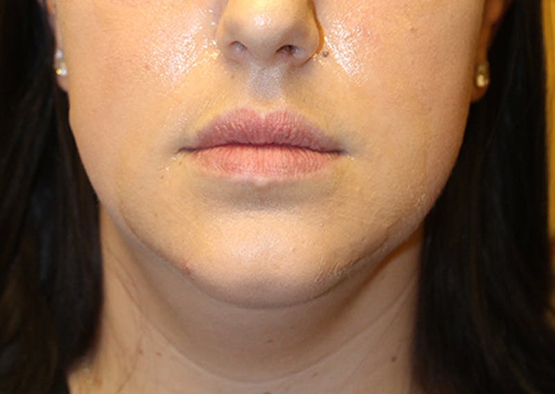 Injectables Before & After Gallery - Patient 174146623 - Image 1