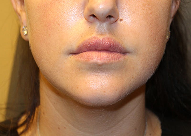 Injectables Before & After Gallery - Patient 174146623 - Image 2
