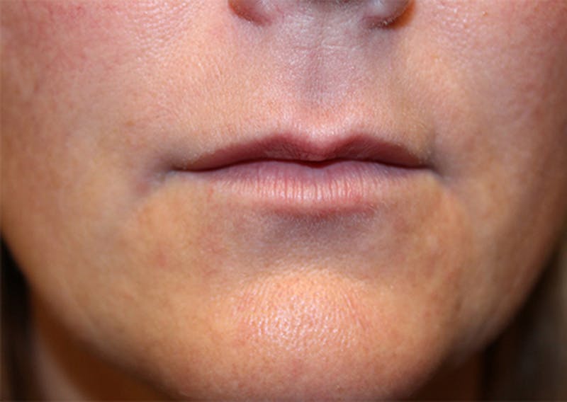 Injectables Before & After Gallery - Patient 174147703 - Image 1