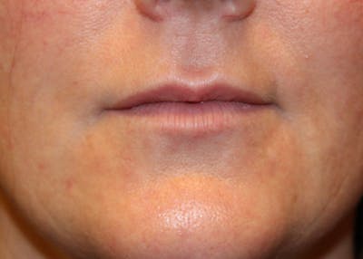 Injectables Before & After Gallery - Patient 174147703 - Image 2