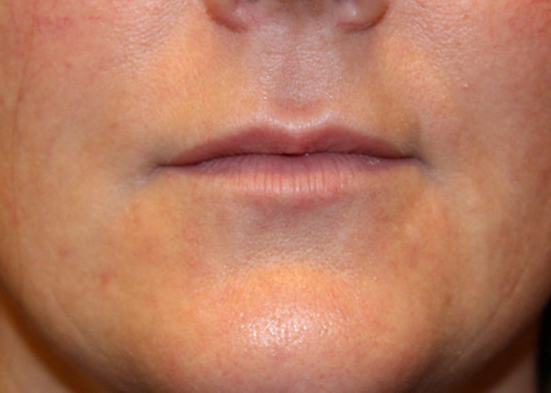 Injectables Before & After Gallery - Patient 174147703 - Image 2