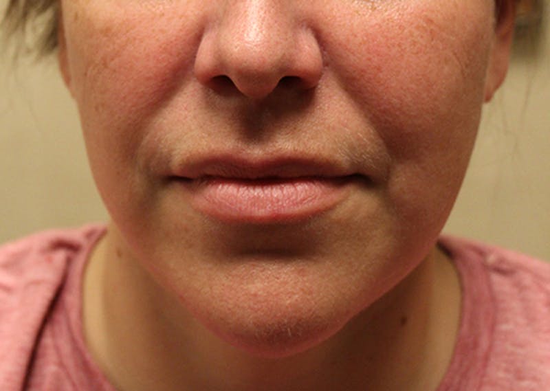 Injectables Before & After Gallery - Patient 174147712 - Image 1