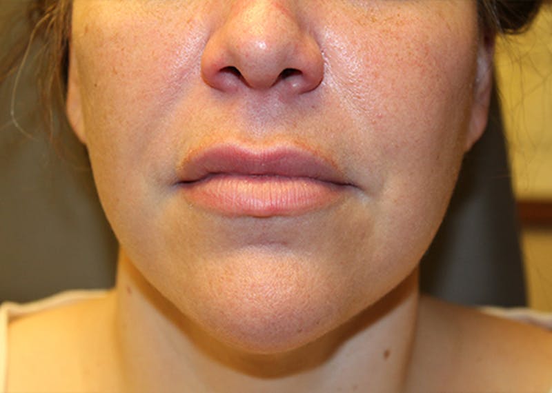 Injectables Before & After Gallery - Patient 174147712 - Image 2