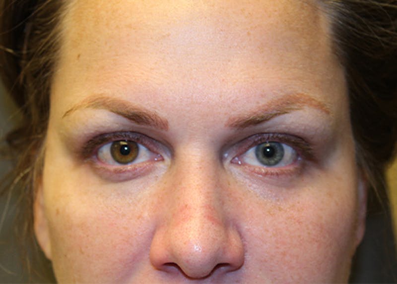 Injectables Before & After Gallery - Patient 174147712 - Image 4