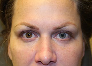 Injectables Before & After Gallery - Patient 174147712 - Image 4