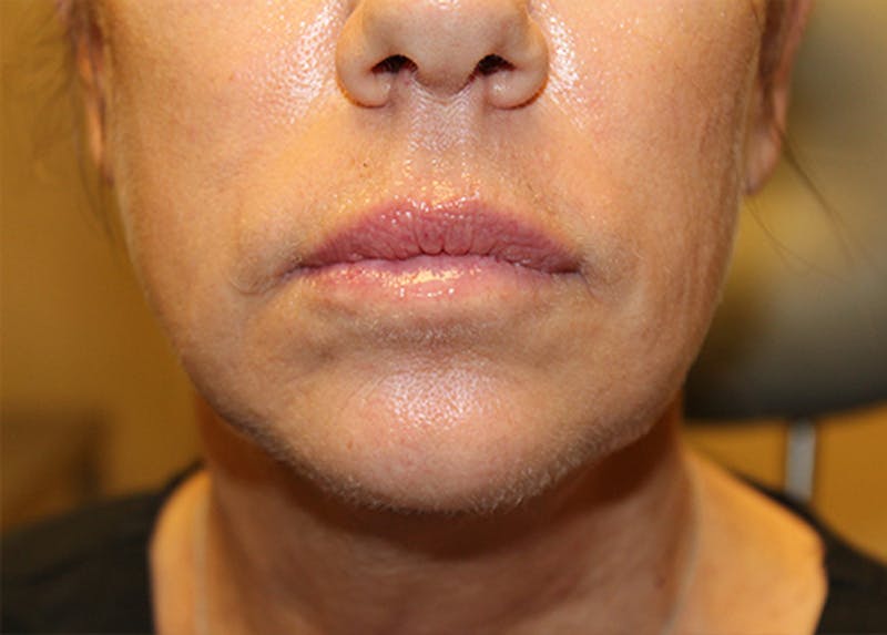 Injectables Before & After Gallery - Patient 174147778 - Image 1