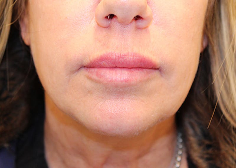 Injectables Before & After Gallery - Patient 174147778 - Image 2