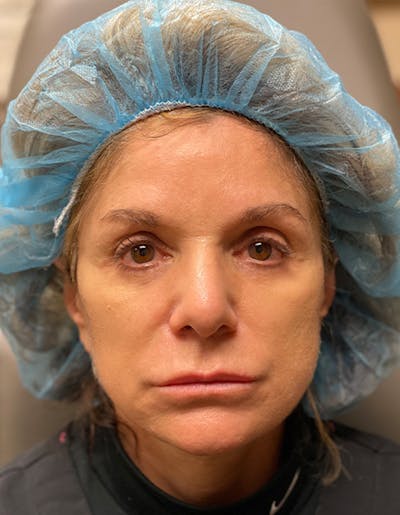 Injectables Before & After Gallery - Patient 174148872 - Image 1