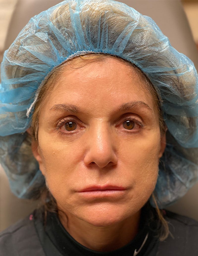 Injectables Before & After Gallery - Patient 174148872 - Image 1