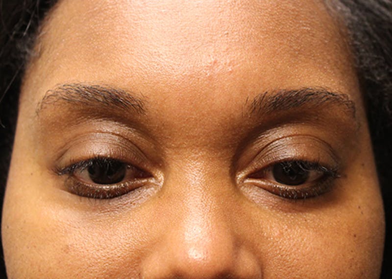 Injectables Before & After Gallery - Patient 174148879 - Image 1