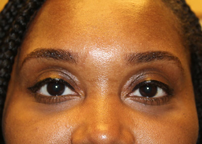 Injectables Before & After Gallery - Patient 174148879 - Image 2