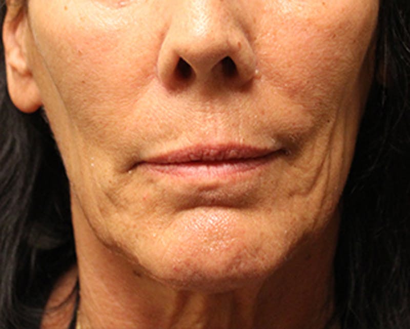 Injectables Before & After Gallery - Patient 174148886 - Image 1