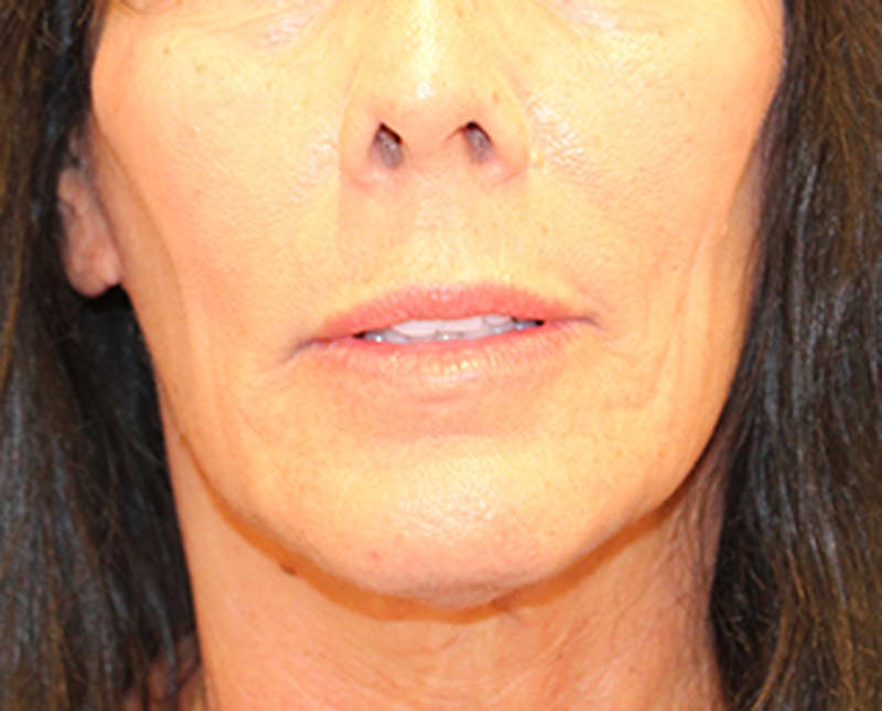 Injectables Before & After Gallery - Patient 174148886 - Image 2