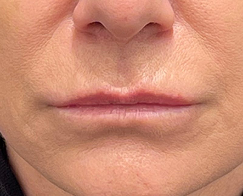 Injectables Before & After Gallery - Patient 174149966 - Image 1