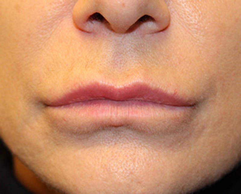 Injectables Before & After Gallery - Patient 174149966 - Image 2