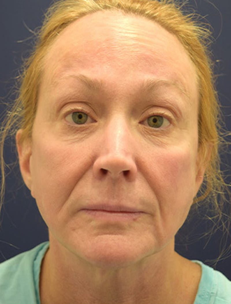 Necklift Before & After Gallery - Patient 177626155 - Image 1