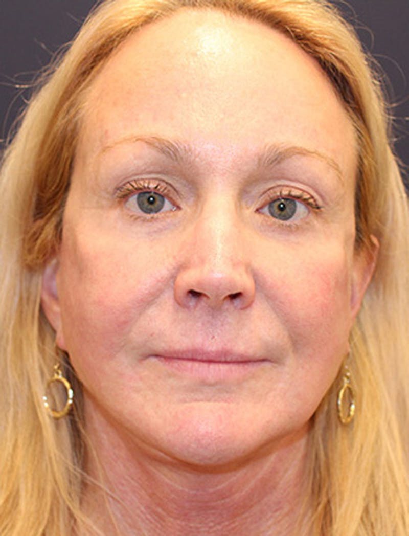 Necklift Before & After Gallery - Patient 177626155 - Image 2