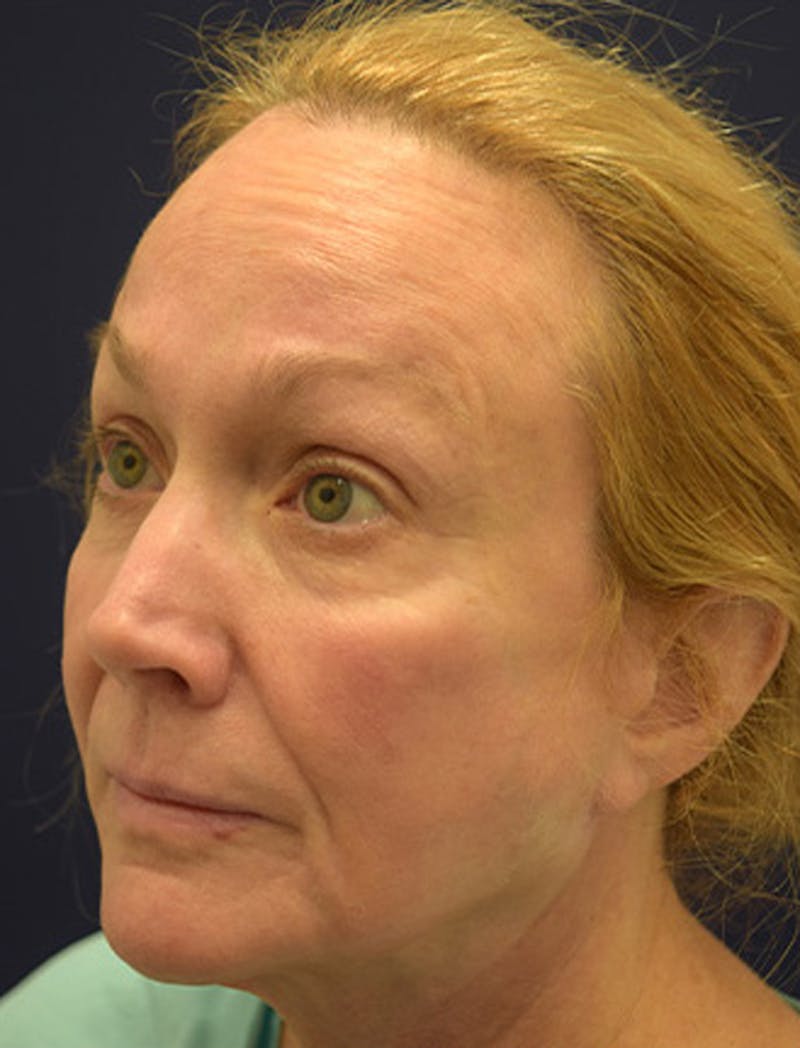 Necklift Before & After Gallery - Patient 177626155 - Image 3