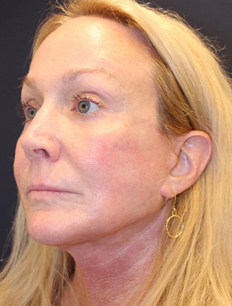 Necklift Before & After Gallery - Patient 177626155 - Image 4