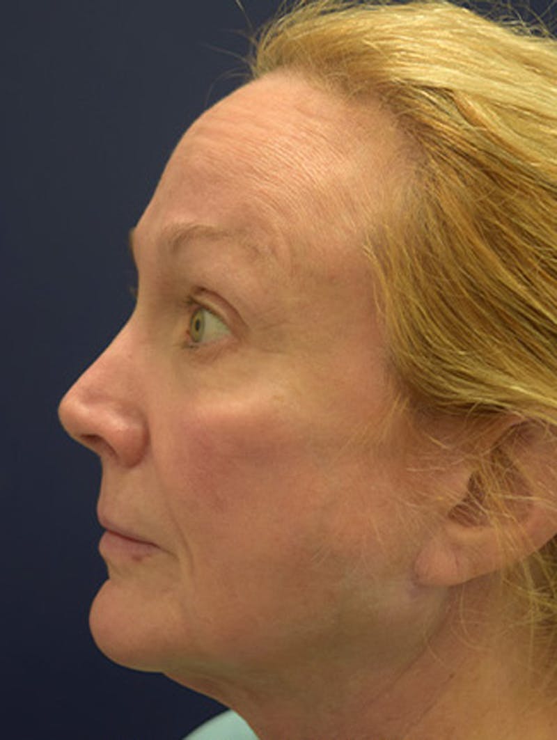Necklift Before & After Gallery - Patient 177626155 - Image 5