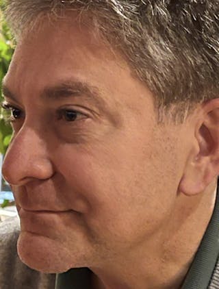 Botox / Dysport Before & After Gallery - Patient 174146460 - Image 4