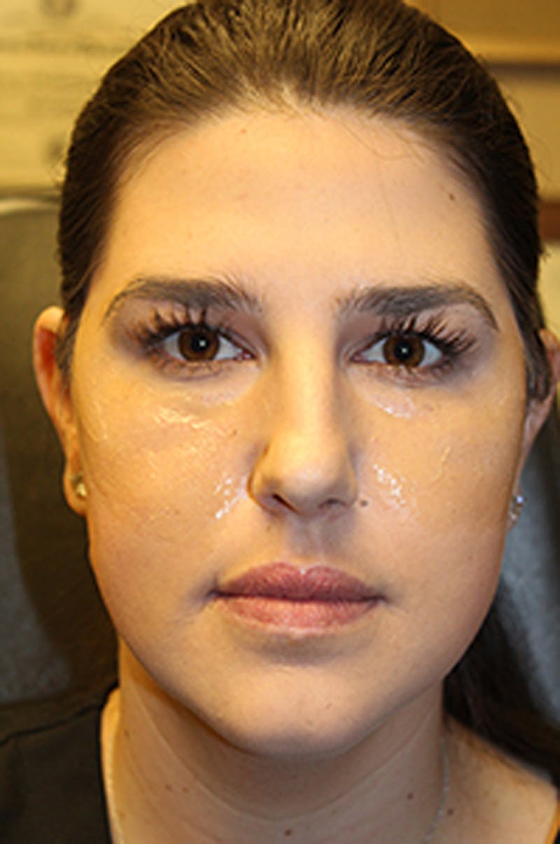 Botox / Dysport Before & After Gallery - Patient 174146488 - Image 1