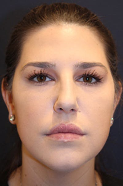 Botox / Dysport Before & After Gallery - Patient 174146488 - Image 2