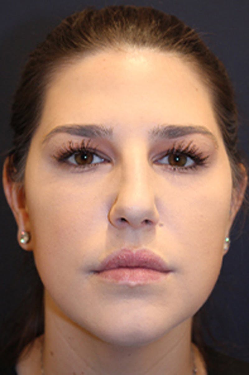 Botox / Dysport Before & After Gallery - Patient 174146488 - Image 2