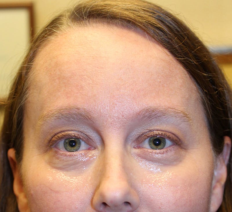Botox / Dysport Before & After Gallery - Patient 174146494 - Image 1