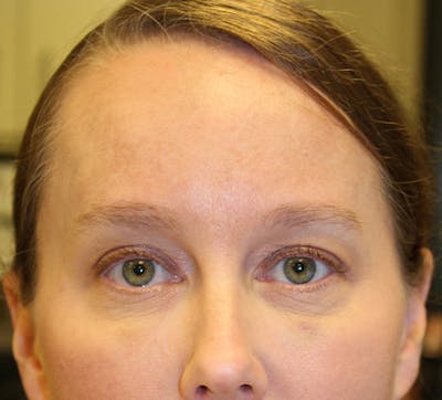 Botox / Dysport Before & After Gallery - Patient 174146494 - Image 2