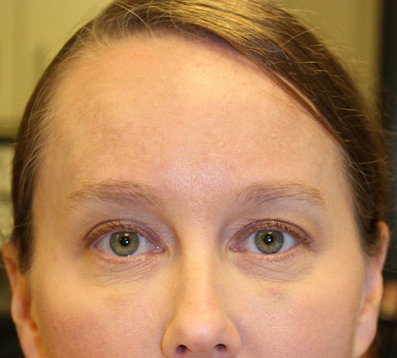 Botox / Dysport Before & After Gallery - Patient 174146494 - Image 2