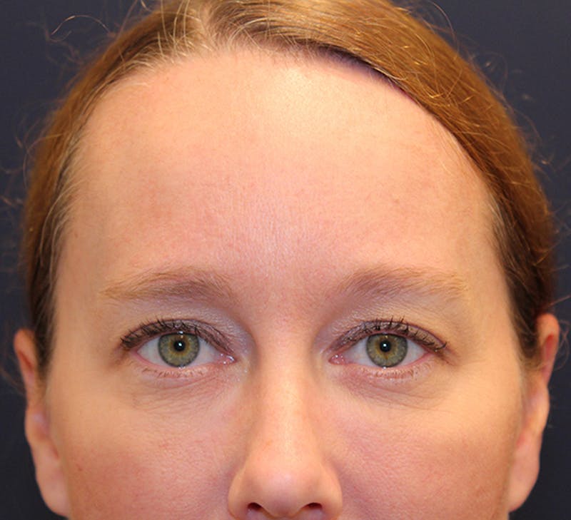 Botox / Dysport Before & After Gallery - Patient 174146494 - Image 3
