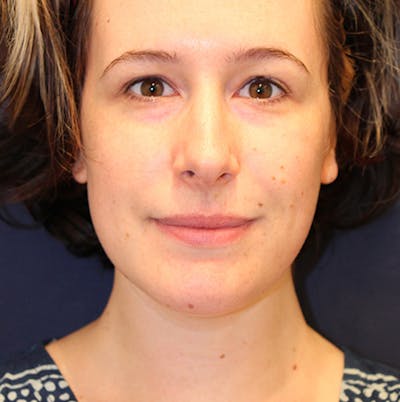 Neck Liposuction Before & After Gallery - Patient 174146483 - Image 2