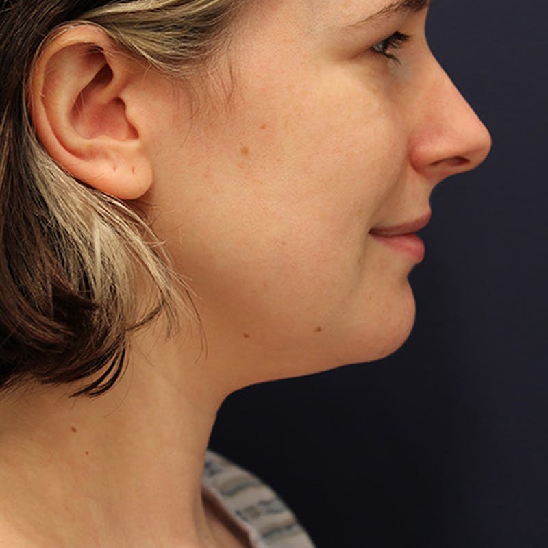 Neck Liposuction Before & After Gallery - Patient 174146483 - Image 5
